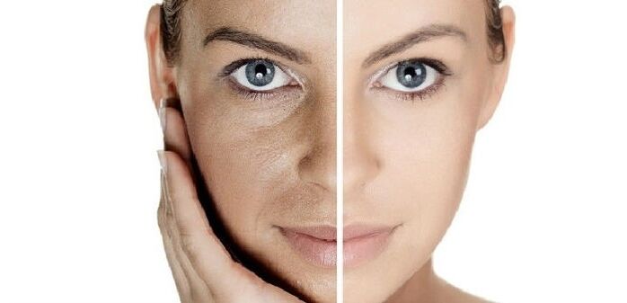Antes y después del rejuvenecimiento facial. 
