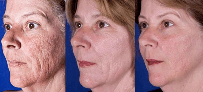 Resultados después del procedimiento de rejuvenecimiento facial con láser