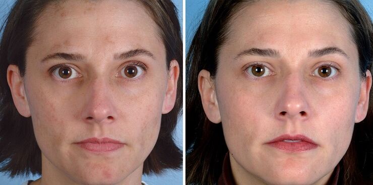 Antes y después de usar el dispositivo para rejuvenecer la piel. 