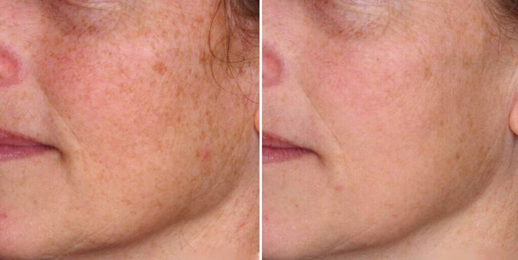 Antes y después del rejuvenecimiento de la piel del rostro