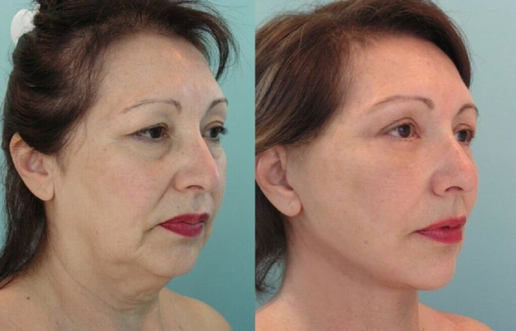 Fotos de antes y después del rejuvenecimiento de la piel. 